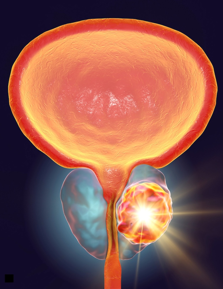 Terapia Focal no Câncer de Próstata - Dr. Mauricio Murce - Urologia