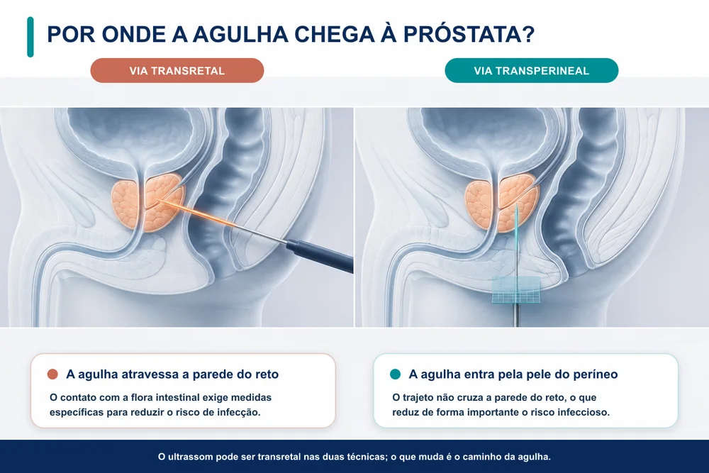 infografico demonstrando a diferença entre a biópsia transperineal e a biópsia transretal
