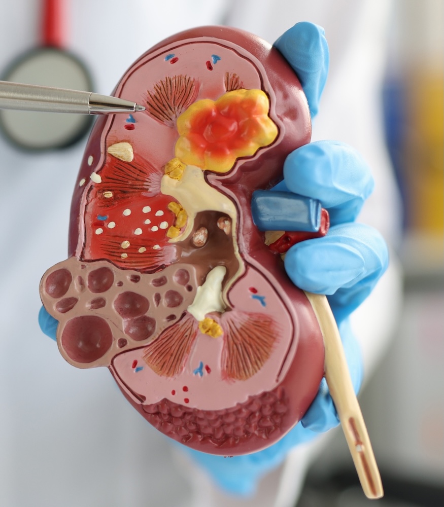 Câncer de Rim - Dr. Mauricio Murce - Urologia