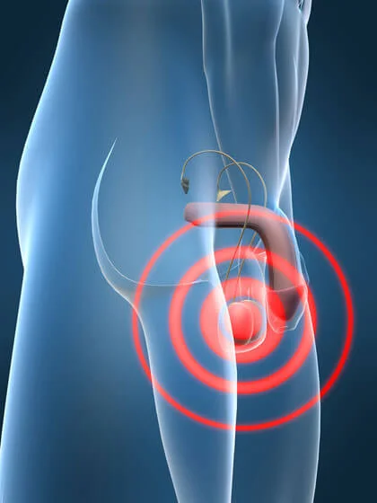 Câncer de Testículo - Dr. Mauricio Murce - Urologia