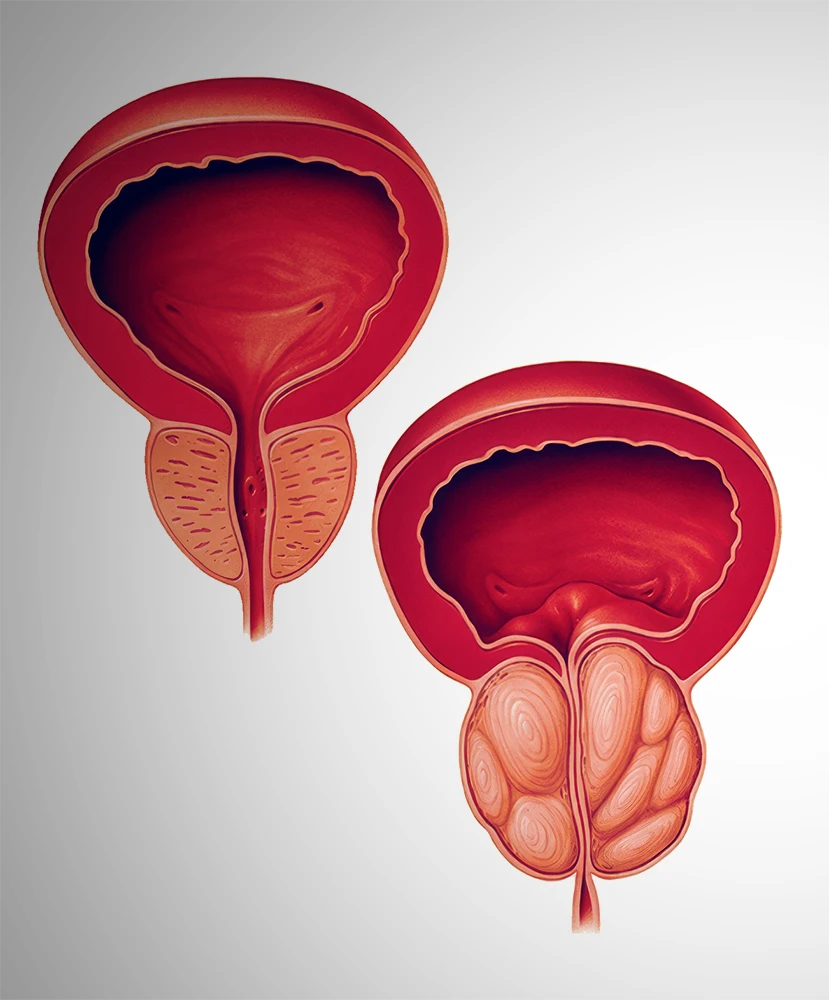Hiperplasia Prostatica Benigna - Dr. Mauricio Murce - Urologia