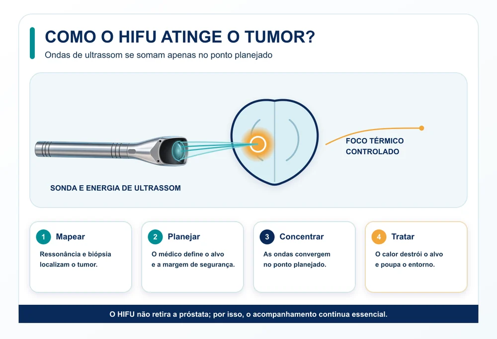 Como funciona o HIFU no câncer de próstata e a concentração da energia sobre o tumor