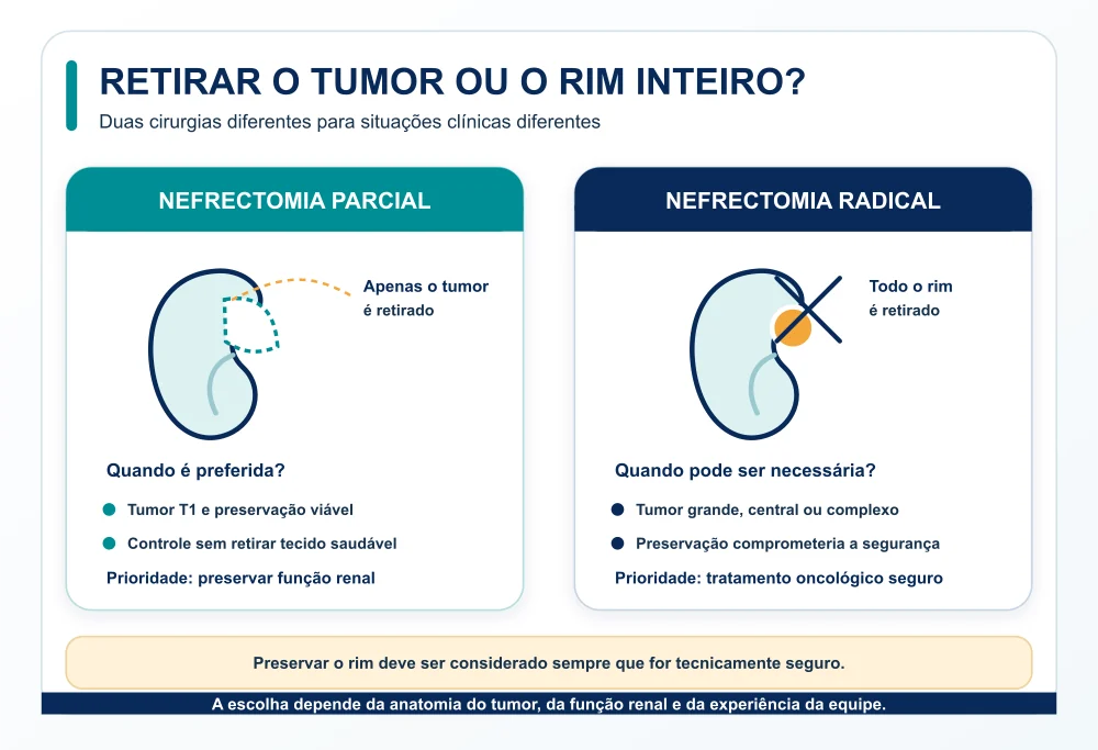 Tratamentos do nódulo renal incidental: nefrectomia parcial e radical